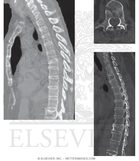CT of Osteoporosis In the Thoracic Spine