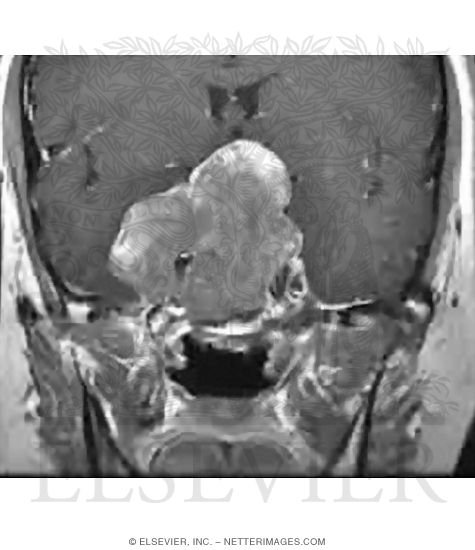 Pathologic Vs. Normal Tissue