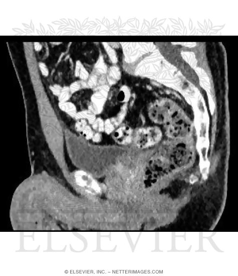 Male Pelvis CT Scan