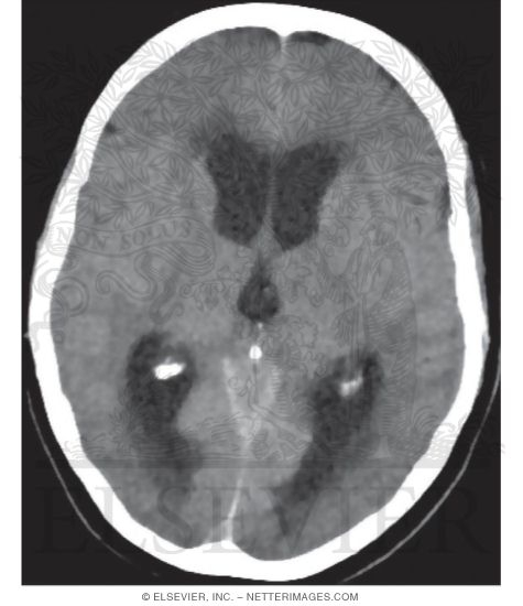 Axial CT of a Patient With Obstructive Hydrocephalus