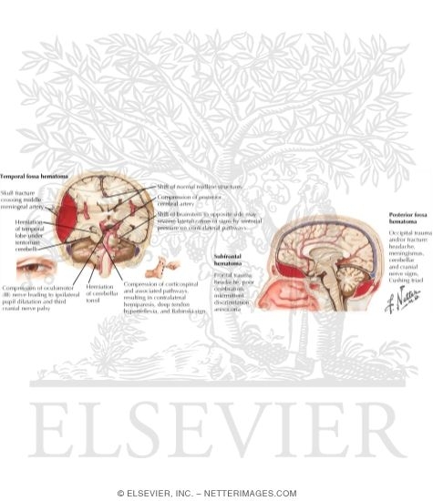 Epidural Hemorrhage