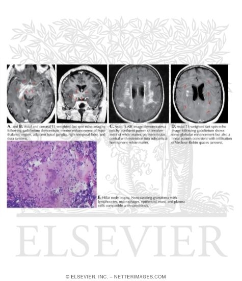 Neurosarcoidosis: MRI and Pathology