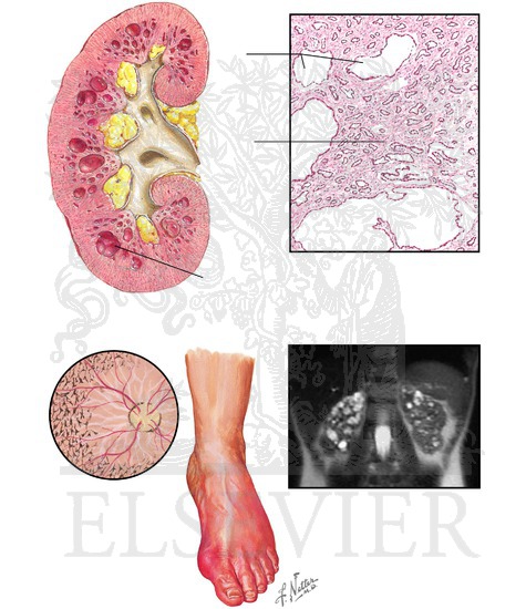 Nephronophthisis/Medullary Cystic Kidney Disease Complex