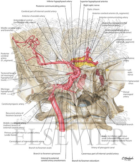 Internal Carotid Artery in Petrous Part of Temporal Bone 