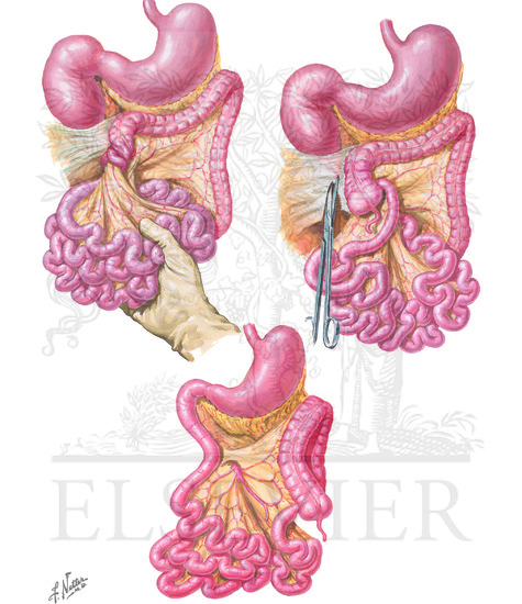 intestinal atresia