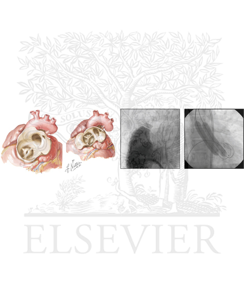 Congenital Aortic Valve Stenosis and Double-Balloon Valvuloplasty