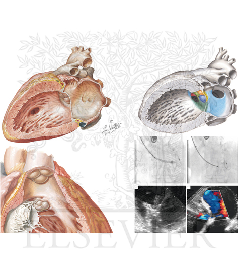 Anatomic features of perimembranous versus muscular ventricular septal defects and depiction of (A) postinfarction ventricular septal defect occluder implant and (B) follow-up echocardiogram