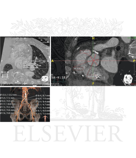(A) Assessing the size of the aortic annulus to determine appropriate valve selection. (B) Measurements of the sinuses of Valsalva to ensure adequate coronary filling after transcatheter aortic valve replacement. (C) Assessing the diameters of the peripheral arteries to determine appropriate vascular access