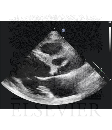 Echocardiogram Findings in Severe Infective Endocarditis of Aortic Valve