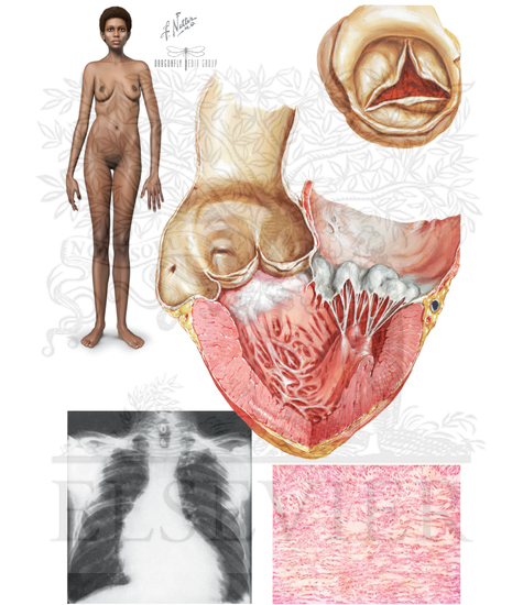 Cystic Medial Necrosis of Aorta