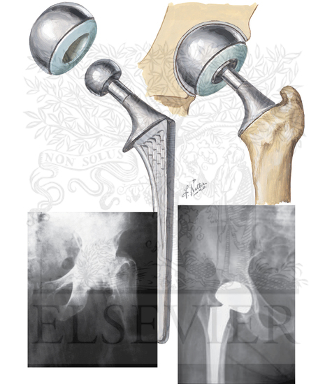 Total Hip Replacement: Bipolar Prosthesis Hemiarthroplasty of Hip