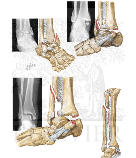 Rotational Fractures