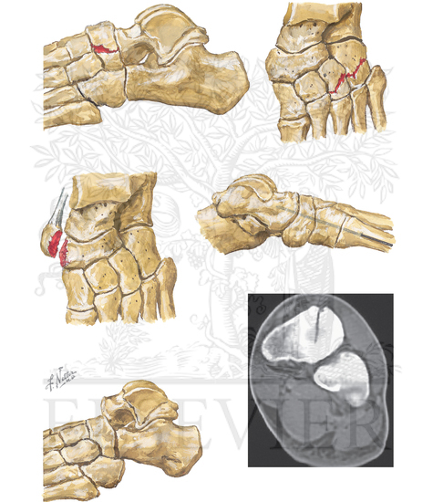 Navicular Stress Fractures