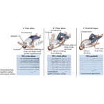 Generalized Tonic-Clonic Seizures